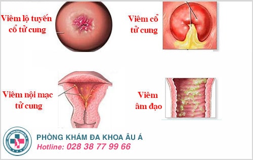 chậm kinh ra máu nâu
